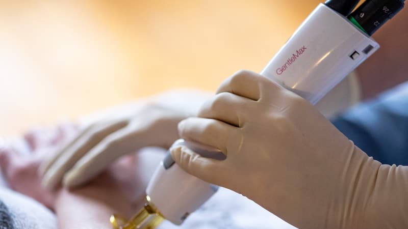 Pieza de mano del Candela GentleMax durante una sesión de depilación láser